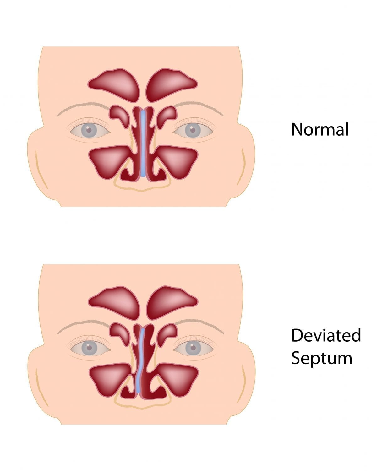 Deviated septum tinnitus fashion